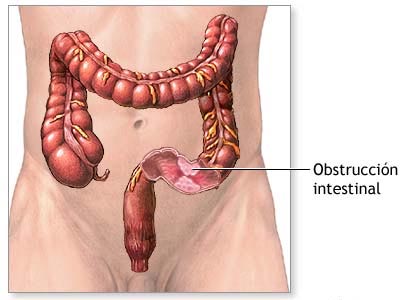 Obstrucción intestinal en enfermos de Crohn 1